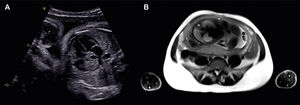 Prenatal imaging study. (A) Fetal echocardiogram image showing a large (2 cm×2 cm) and well-circumscribed lesion with heterogeneous content at the right atrium level, extending to the upper mediastinum, suspicious of teratoma. (B) Fetal magnetic resonance image showing a mass on the right atrium with hypersignal in T2, hyposignal in T1, and no fat, suggestive of hemangioma.
