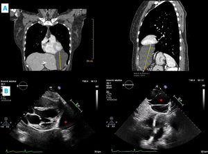 (A) Chest computed tomography (lateral short-axis view) showing a cystic lesion in the left costophrenic angle (the yellow lines indicate length and depth: 8 cm×7 cm×10 cm); (B) echocardiogram confirming a pleuropericardial cyst (red asterisk).