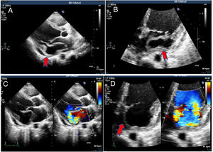 2D Echo in parasternal long axis view (A) and (C) (with colour Doppler) and AP4-chamber view (B) and (D) (with colour Doppler) showing aneurysm in the submitral area (red arrow) with to and fro flow into the cavity, with severe mitral regurgitation.