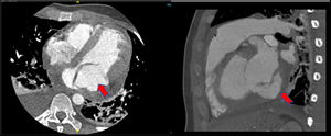 Cardiac CT showing aneurysmal dilatation (red arrow) of the base of left ventricle along the mitral annulus with prolapse of posterior mitral leaflet into left atrium.
