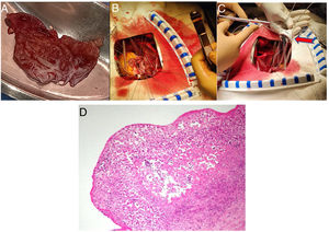 Intraoperative image showing the excised submitral aneurysm specimen (A), mitral annular reconstruction (B) and On-X mechanical prosthetic valve (red arrow) implantation (C), histopathological examination of aneurysm specimen showing necrotizing epithelioid cell granulomas with giant cells (D).
