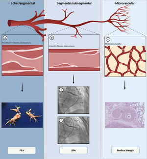 The pathophysiology and multimodality treatment of chronic thromboembolic pulmonary hypertension. (a) Proximal lesions in lobar and segmental arteries (top); fibrotic, collagen-rich lesions, treated by pulmonary endarterectomy (bottom); (b) distal lesions in segmental and subsegmental arteries (top); balloon pulmonary angioplasty in a segmental branch (bottom) before (1) and after (2); (c) microvasculopathy lesions (top); small arteries with intimal thickening and fibrosis, which are treated with medical therapy (bottom). BPA: balloon pulmonary angioplasty; PA: pulmonary artery; PEA: pulmonary endarterectomy. Created with BioRender.com.