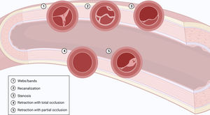 Types of vascular lesions in chronic thromboembolic pulmonary disease. Created with BioRender.com.
