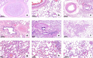 Histopathology of chronic thromboembolic pulmonary hypertension in explanted lungs (H&E stain). (a) A thrombus underwent organization and recanalization within the lumen of a proximal branch of the pulmonary artery; (b) aggregates of foamy histiocytes denote atheromatous lesions in a large-caliber vessel, pictured alongside small parenchymal venules with remodeling; (c–e) proximal and subsegmental branches of the pulmonary artery exhibit a range of fibromuscular proliferation and fibrosis (±calcification) of the wall; (f) an area of hemangiomatosis stands out from the surrounding parenchyma, due to broadened alveolar walls; (g and h) higher magnification reveals capillary proliferation, with congestion and extravasated red blood cells; hemosiderophages can be seen within the alveolar spaces; (i) small parenchymal venules, usually inconspicuous, become readily recognizable due to marked thickening of the wall.