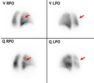 Planar V/Q scan in a chronic thromboembolic pulmonary hypertension patient with multiple perfusion defects. The red arrows highlight a ventilation/perfusion mismatch in the superior segment of the right lower lobe, seen from two different angles. LPO: left posterior oblique; Q: perfusion, RPO: right posterior oblique, V: ventilation.