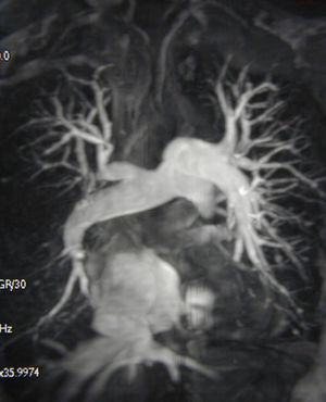 Magnetic resonance imaging angiogram demonstrating chronic thromboembolic pulmonary hypertension in an operable distribution, affecting the right middle and lower lobes as well as the left lower lobe. There is also evidence of tricuspid regurgitation with retrograde flow of contrast into the hepatic veins.