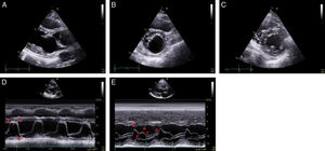 Transthoracic echocardiography. Two-dimensional parasternal long-axis (A) and short-axis [(B) mitral valve level, (C) papillary muscle level] views; M-mode images at the level of the mitral leaflets of the present unileaflet mitral valve case (D) and of a normal bileaflet mitral valve (E). D point: initial diastolic leaflet opening; E point: maximum leaflet opening during the phase of rapid ventricular filling ending at the F point; A point: maximum leaflet opening during atrial contraction; C point: leaflet coaptation point at the beginning of systole. In the present case of a unileaflet mitral valve (D), there is loss of the F point (asterisk) with a flat E-A wave in constant contact with the anterior interventricular septum, corresponding to the opening of the elongated anterior mitral leaflet throughout diastole, while the coaptation point C is posteriorly displaced.