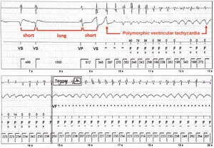 Premature ventricular contractions and low pacing rate creating a ‘short-long-short’ pattern and inducing polymorphic ventricular tachycardia.