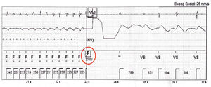 Successful termination of ventricular tachycardia by a 30-J implantable cardioverter-defibrillator shock.