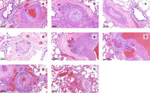 Histopathology of vascular changes of pulmonary hypertension in explanted lungs. (a) Muscular hypertrophy of the media and proliferation of intimal cells narrow the lumen of a pulmonary artery branch; adventitial fibrosis can also be detected; (b) an artery shows concentric laminar fibrosis of the intima, imparting an onion skin-like appearance to the vessel profile; (c) a pulmonary artery lumen is fully occluded; (d) the wall of a small artery is replaced by fibrin and inflammatory cells, causing loss of its architecture, in this example of necrotizing vasculitis; (e–g) a glomeruloid network of small vascular channels, the hallmark of plexiform lesions, can be seen arising from muscular arteries; (h) angiomatoid lesions, characterized by dilated and convoluted vessels with a thin wall, can be seen distal to a plexiform lesion (right corner).