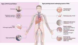 Left: clinical signs suggesting right ventricular failure; right: signs suggesting possible underlying etiologies of pulmonary arterial hypertension. CHD: congenital heart disease; CTEPH: chronic thromboembolic pulmonary hypertension; GERD: gastroesophageal reflux disease; HHT: hereditary hemorrhagic telangiectasia; PDA: patent ductus arteriosus; PPHTN: portopulmonary hypertension; PVOD: pulmonary veno-occlusive disease; RV: right ventricular; SSc: systemic sclerosis.