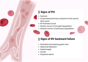 Clinical signs suggesting pulmonary hypertension and right ventricular backward failure. RV: right ventricular.