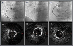 Illustrative example of IVUS-guided, OA-facilitated PCI of a calcified RCA. A1: severe diffuse calcified lesion on the proximal and mid segments; B1: OA placed in the mid segment of the RCA and several advancements and retreatments were made; C1: final angiographic result after stenting from the mid-distal segment trough the ostium; A2: severe 360° calcified lesion of the RCA; B2: revaluation after OA showing adequate sanding (echo reverberations) and luminal gain; C2: final imaging after stenting showing overall good apposition and expansion. IVUS: intravascular ultrasound; OA: orbital atherectomy; PCI: percutaneous coronary intervention; RCA: right coronary artery