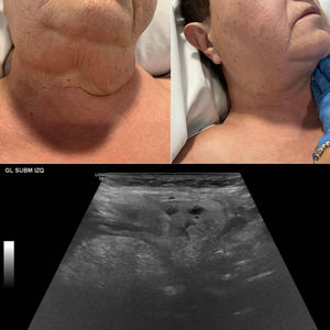 Bilateral, firm swelling of submaxillary glands (predominantly the left submaxillary gland) and ultrasound images showing diffuse and homogeneous enlargement of tissue with no nodular lesions, increased vascularization, and no obstruction in the excretory ducts consistent with non-infectious sialadenitis.