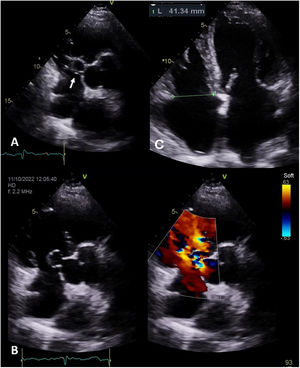 Transthoracic echocardiogram: (A) PSAX base view showing SOVA occupying the right atrium - white arrow; (B) PLAX Doppler view showing SOVA with aorta to right atrium shunt; (C) A4C view with dilatation of the right heart chambers.