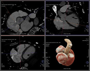 CT angiography showing the SOVA (white arrow).