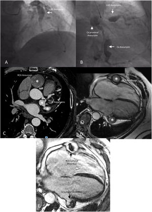 Giant coronary aneurysms seen by invasive coronary angiography (panels A and B), computed tomography coronary angiography (panel C) and cardiac MRI bSSFP cine (panel D) and late gadolinium enhancement (panel E), the latter revealing thrombi in the circumflex and right coronary arteries. bSSFP: balanced Steady-State Free Precession; Cx: circumflex artery; LAD: left anterior descendant artery; RCA: right coronary artery.