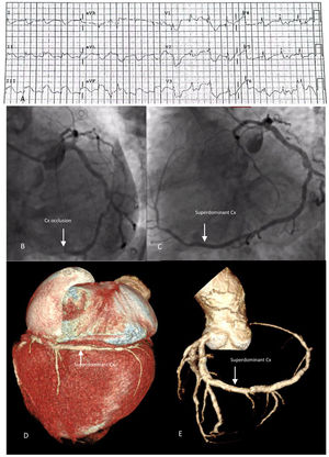 Panel A: ECG with ST-segment elevation in the inferior leads. Panel B: Circunflex (Cx) artery occlusion (arrow) during coronary angiography. Panel C shows a superdominant Cx artery after angioplasty. Panels D and E are CT scan images showing a superdominant Cx artery and absence of right coronary artery (coronary agenesis).