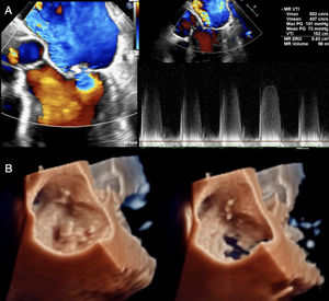 (A) Echocardiogram showing severe mitral valve regurgitation. (B) Three-dimensional echocardiogram showing vegetations in the left atrium.