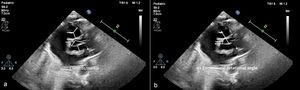 Echocardiographic evaluation: (a) measuring the C-ratio and (b) measuring the commissural rotation angle.