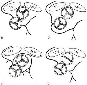 Malalignment pattern according to sinus-facing valve or rotated valve. (a) Sinus-facing of the pulmonary valve, (b) sinus-facing of the aortic valve, (c) sinus-facing of both valves and (d) bicuspid pulmonary valve.