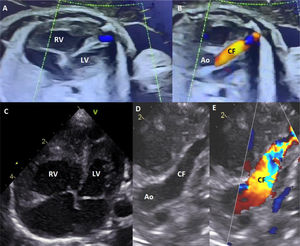 Prenatal and postnatal echocardiograms showing right ventricular dilatation and large coronary fistula. (A) Prenatal 4-chamber view with right ventricular dilatation, compared to the left ventricle. (B) Prenatal view showing a large coronary fistula with antegrade flow from the aorta to the apex of the right ventricle. (C) Postnatal 4-chamber view with right ventricular dilatation. (D and E) Postnatal view showing a large coronary fistula with antegrade flow from the aorta. Ao: aorta; CF: coronary fistula; LV: left ventricle; RV: right ventricle.