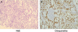 Anatomo-patologia (A - H & E, B - citoqueratina): alterações difusas do parênquima pulmonar; alargamento marcado dos septos alveolares, edema e focos de infiltrado linfocítico leve a moderado, com raros neutrófilos e alguns eosinófilos. Proliferação intra-alveolar frequente de miofibroblastos com pequenos nódulos presentes. Estes são parcialmente revestidos por pneumócitos altamente reactivos. Não são identificados granulomas, trombos vasculares ou proliferação neoplásica. Estes aspectos são indicativos de um processo de pneumonia intersticial organizativa e exsudativa.