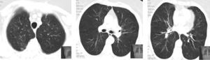 Tomografia computadorizada do tórax – resolução dos infiltrados pulmonares.