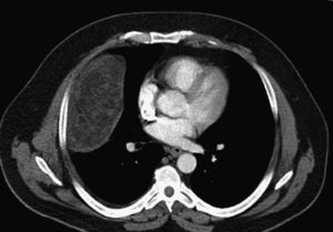 A large mass in the right hemi-thorax with low density suggestive of a lipoma/liposarcoma.