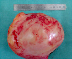 Gross appearance of the excised mass after removal from the chest.