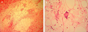 (a) Medium power photomicrograph showing mature adipocytes separated by collagenous fibrous tissue (sclerosing feature). An occasional lipoblast with an enlarged hyper chromatic nucleus is evident within the fat. (b) High power view showing an atypical lipoblast, the presence of which indicates malignant well differentiated sclerosing liposarcoma.
