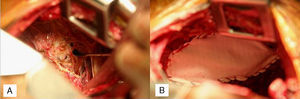 (A) Diaphragmatic fenestrations. (B) Goretex patch repair of fenestrations.