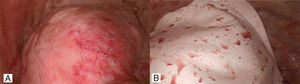 (A) Diaphragmatic surface. (B) Goretex patch of diaphragm.