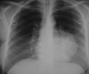 Chest X-ray demonstrating a hilar and paracardial left opacity.