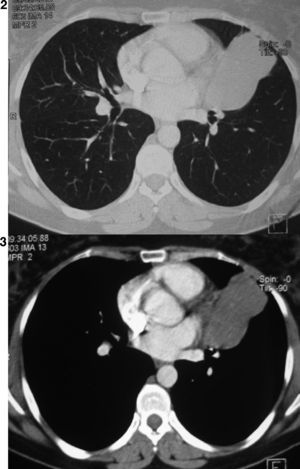 A computed tomography scan showing an inhomogenous mass partially cystic, budding at the lingular bronchi and then develops in intrathoracic without mediastinal lymphadenopathy or pleural effusion.