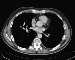 CT image showing the nodule in the middle lobe.