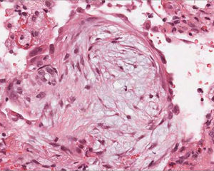 Transbronchial lung biopsy. Intraalveolar fibrotic bud typically observed in cryptogenetic organizing pneumonia.