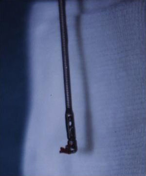 Jumbo forcep with a lung sample that is poured out of the tip of the forceps.