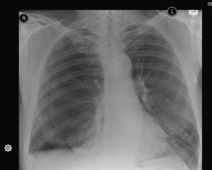 Right side hydropneumothorax with partial collapse of the right lung.