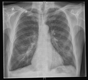 Small right side hydropneumothorax and a chest drain in place.