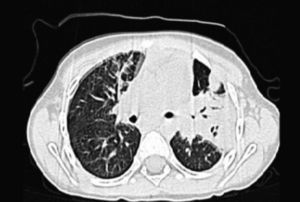 Tomografia axial computorizada a revelar pneumonia do lobo superior e inferior esquerdo.