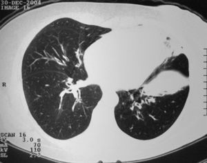 Tomografia computorizada de alta resolução do doente 1 mostrando um infiltrado parenquimatoso na língula e lobo inferior esquerdo e espessamento intersticial peribroncovascular.