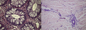 Biopsias cólica (esquerda) e cutânea (direita) mostrando um infiltrado denso de eosinófilos na mucosa cólica e nas paredes dos vasos da pele (HE 400x).