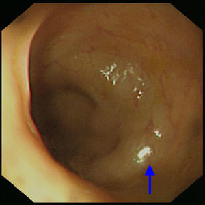 Upper gastrointestinal endoscopy revealed abnormal submucosal elevation in the lower esophagus which was approximately 2–3cm above the esophagogastric junction. There was no superficial mucosal lesion.