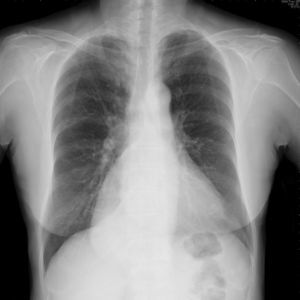 Chest radiograph showed one very large ovoid and well-demarcated opacity in right lower lung field. The silhouette sign is negative because the tumor margin can be differentiated from both the right heart border and diaphragm dome, indicating that the location of tumor is in the posterior mediastinum.