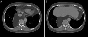 Computed tomographic scans revealed a partial atelectasis of the lung, along with mild displacement of the inferior vena cava and esophagus (A). The fatty neoplasm extends to the thoracoabdominal junction (B).