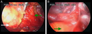 The lesion (white arrow) was found to adhere to the pericardium along with some pericardial fat (green arrow). With careful dissection, the fatty lesion was separated from the pericardium (A). There were adhesions between the lung and the tumor (green arrow) (B).