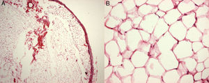 Hematoxylin–eosin staining of the specimen revealed a well-circumscribed lipoma with an intact fibrotic capsule containing mature adipocytes (A, 20×). The mature adipocytes varied slightly in size and shape and had small eccentric nuclei (B, 200×).