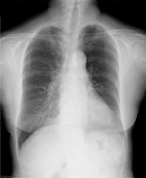 Follow-up chest radiograph 22 months after surgery revealed no evidence of recurrence.