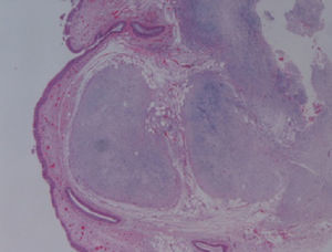 Parede brônquica com neoplasia sub-mucosa, bem limitada, lobulada, de padrão mixóide.